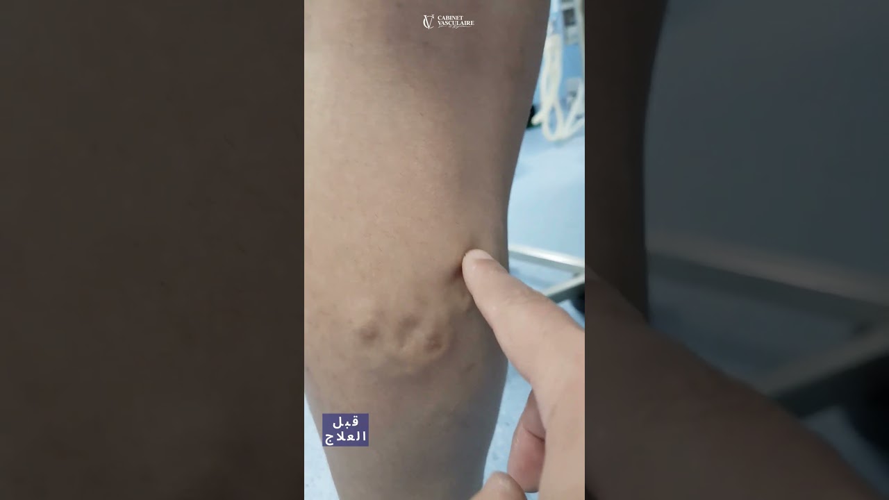 قبل و بعد علاج دوالي الساق بالقسطرة