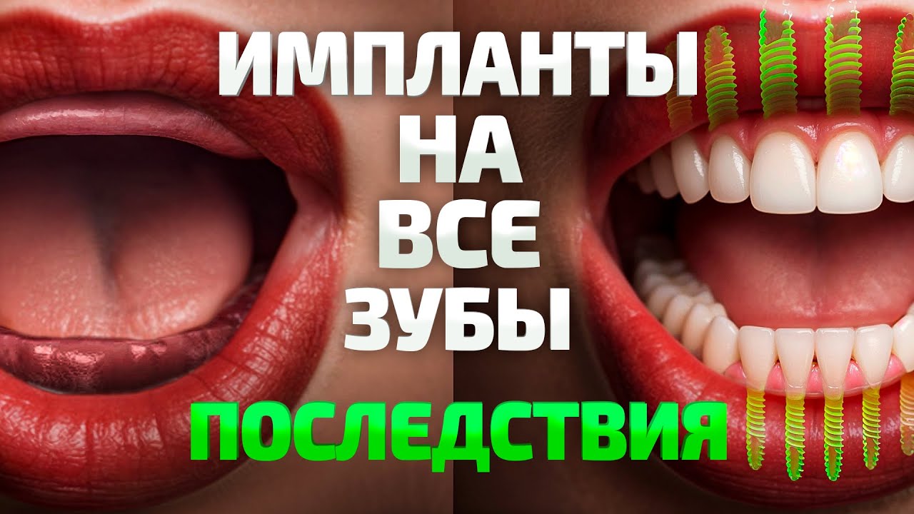 Импланты на все зубы. Что вас ждёт? Последствия о которых молчат!
