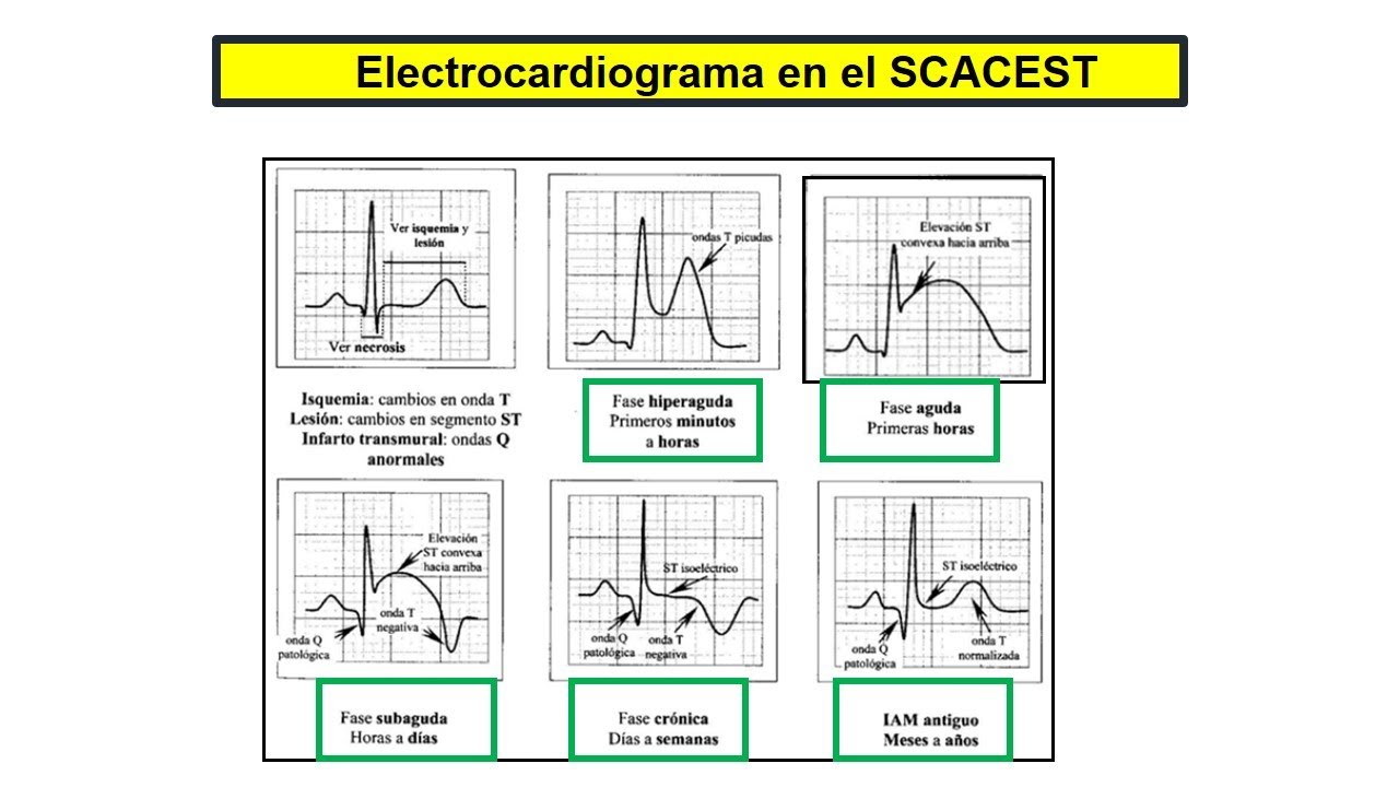 Que debo saber de ECG en SCA para hacer una guardia