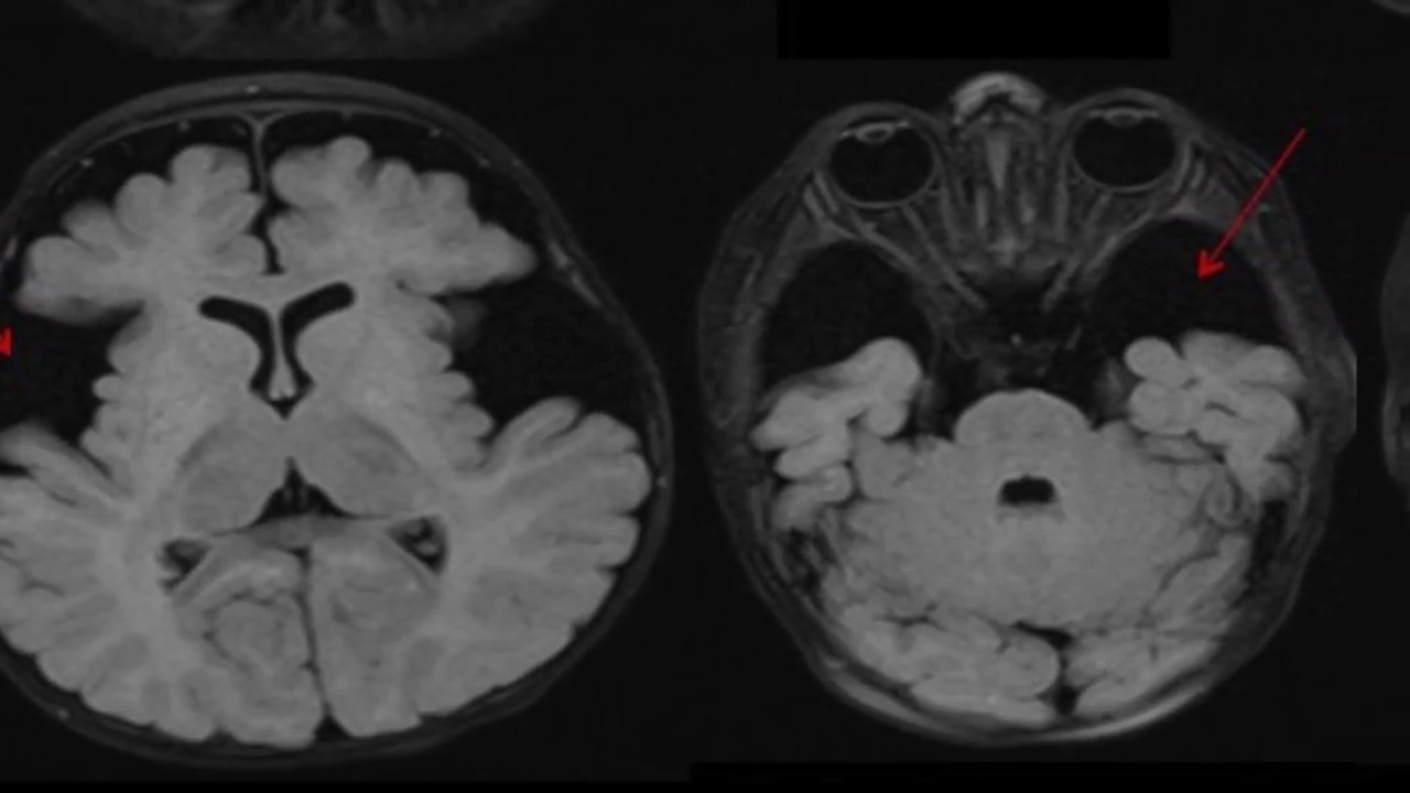 TMT: NEURORADIOLOGY: Short Cases Series 3