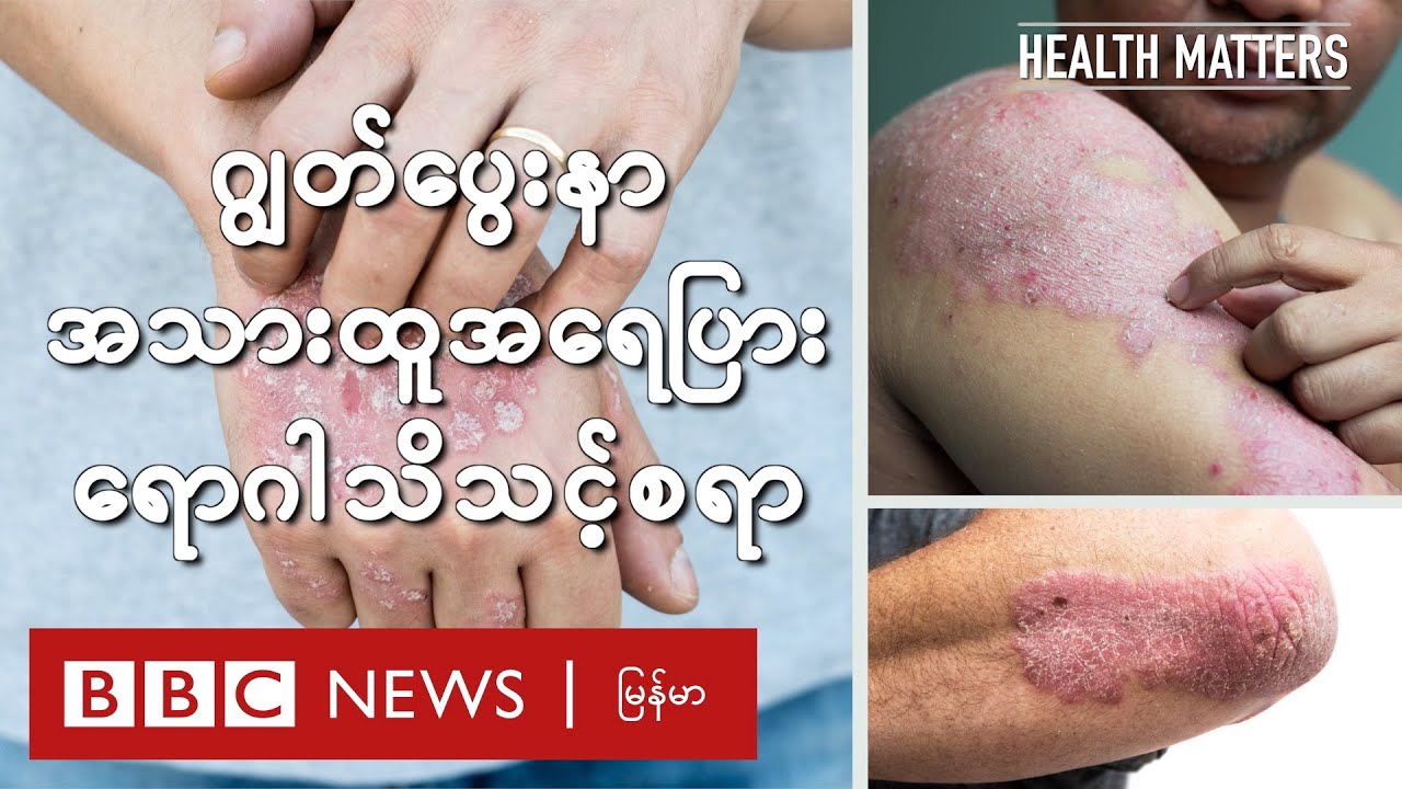 ဂျွတ်ပွေးနာ၊ အသားထူ အရေပြားရောဂါ သိသင့်စရာ - BBC News မြန်မာ