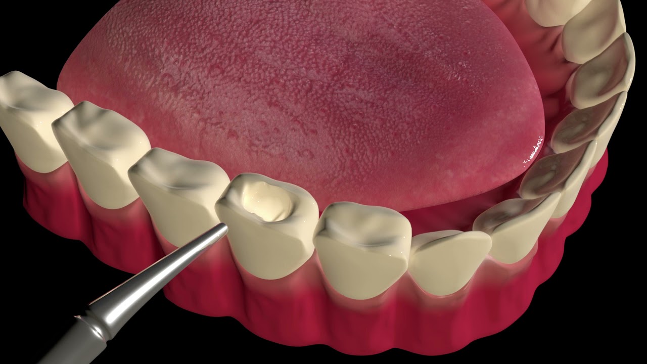 How Does a Dental Filling Work?