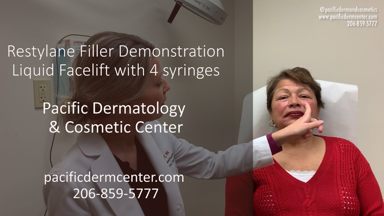 Restylane Lyft, Defyne, Refyne, and Silk - For Filler in 50+ Year Old Woman