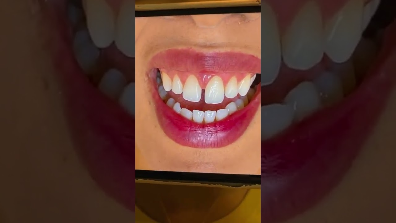 Fechamento de Diastema em Resina Composta, pela Dra Daiane Souza.