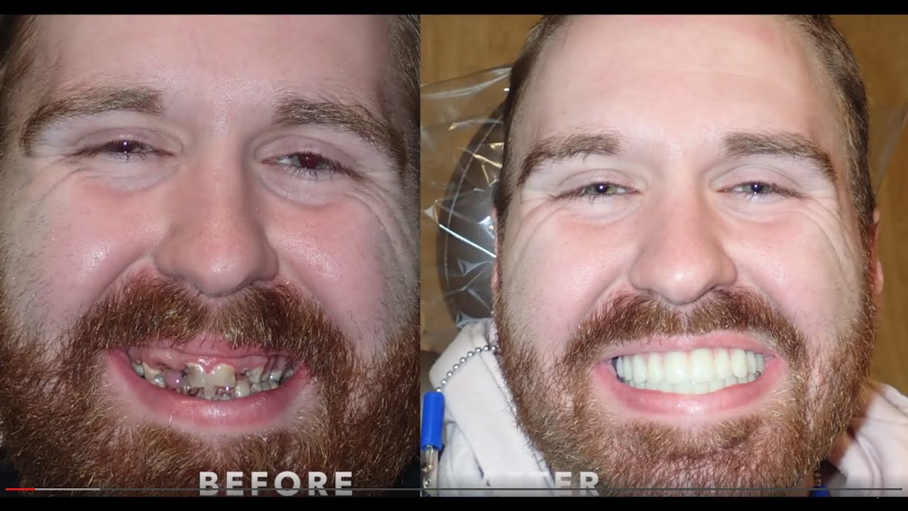 Teeth Now Buffalo vs All on 4, All on X