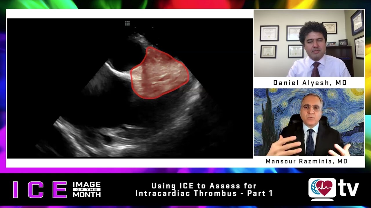 ICE Image of the Month (June 2022) Part I: Using ICE to Assess for Intracardiac Thrombus