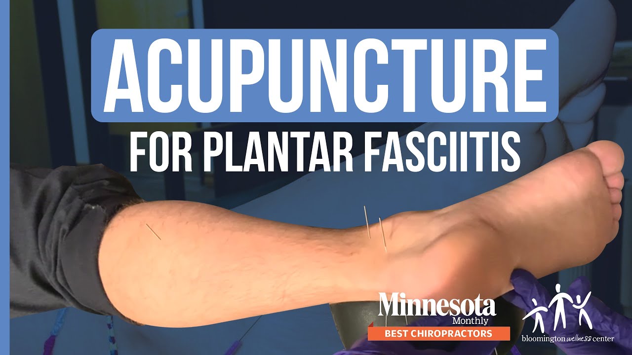 Acupuncture For Plantar Fasciitis At Bloomington Wellness Center | Bloomington Wellness Center
