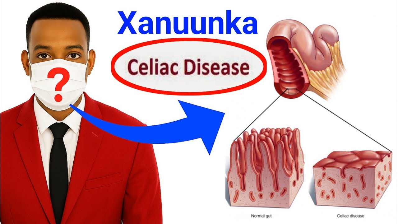 Xanuunka celiac disease ee ku dhaca dheef-shiidka laguna qaldo xanuunka Gaaska maadaama uu..........
