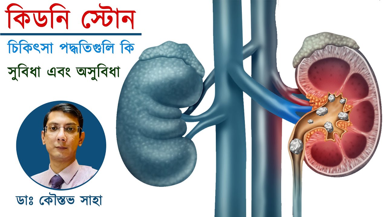 কোন সাইজের পাথরের কি চিকিৎসা এবং তার সুবিধা আর অসুবিধাগুলি কি কি জেনে নিন বিশিষ্ট ইউরোলজিস্টের থেকে।