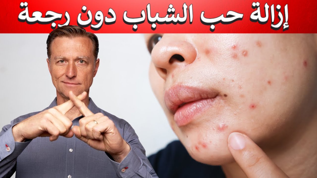 حب الشباب | أسباب مشاكل البشرة وعلاقة الهرمونات - حل نهائي