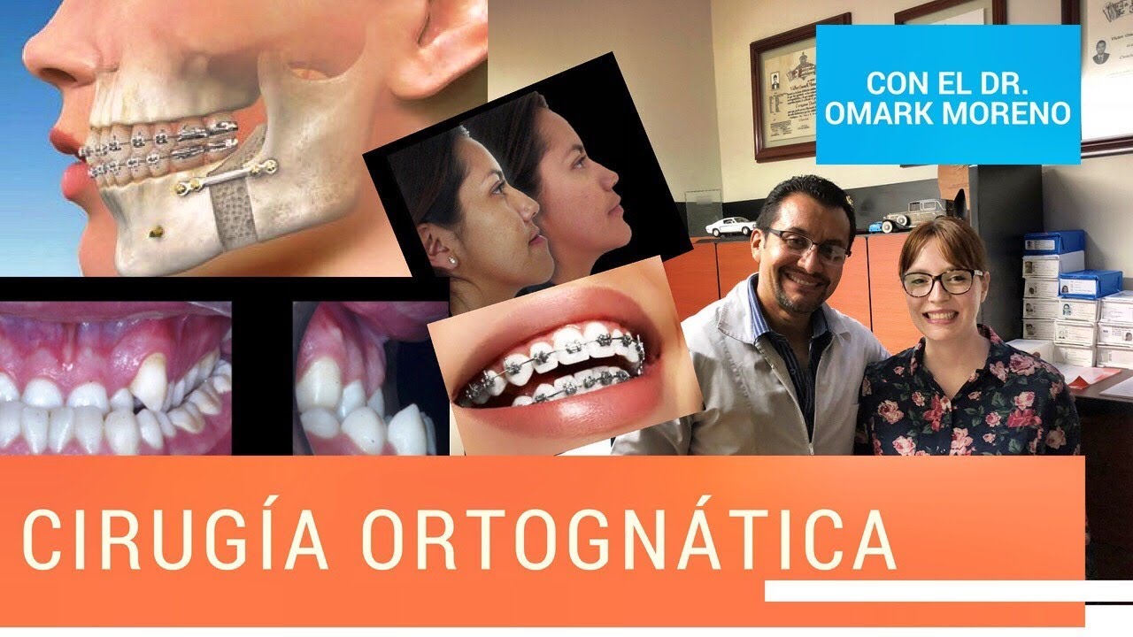 Cirugía Ortognática con Dr Omark Moreno