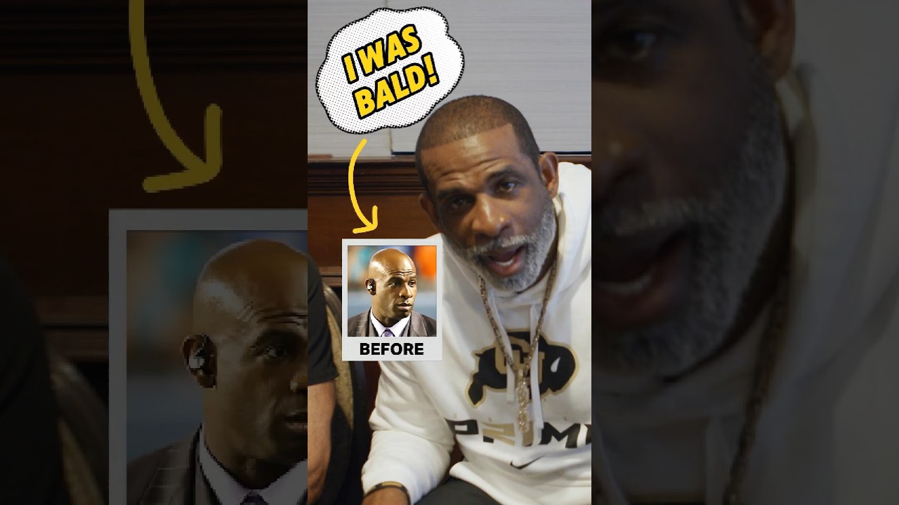 👀 Biggest comeback of all time!? #hair #hairrestoration  #hairlosstreatment #transplant
