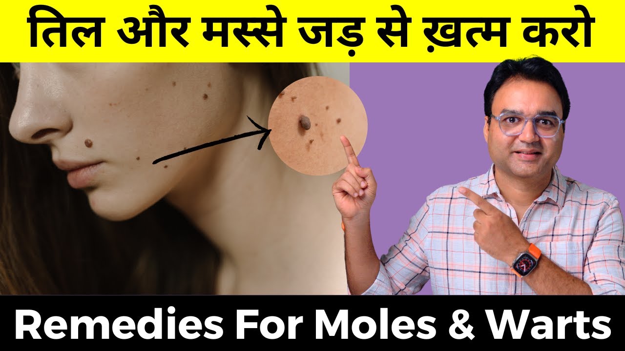 तिल और मस्से बिना लेज़र या सर्जरी जड़ से ख़त्म करें | तिल और मस्से का इलाज | Moles & Warts Treatment
