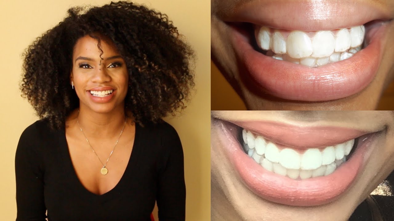 INVISALIGN UPDATE - 3 YEARS LATER - 126 TRAYS ASSIGNED