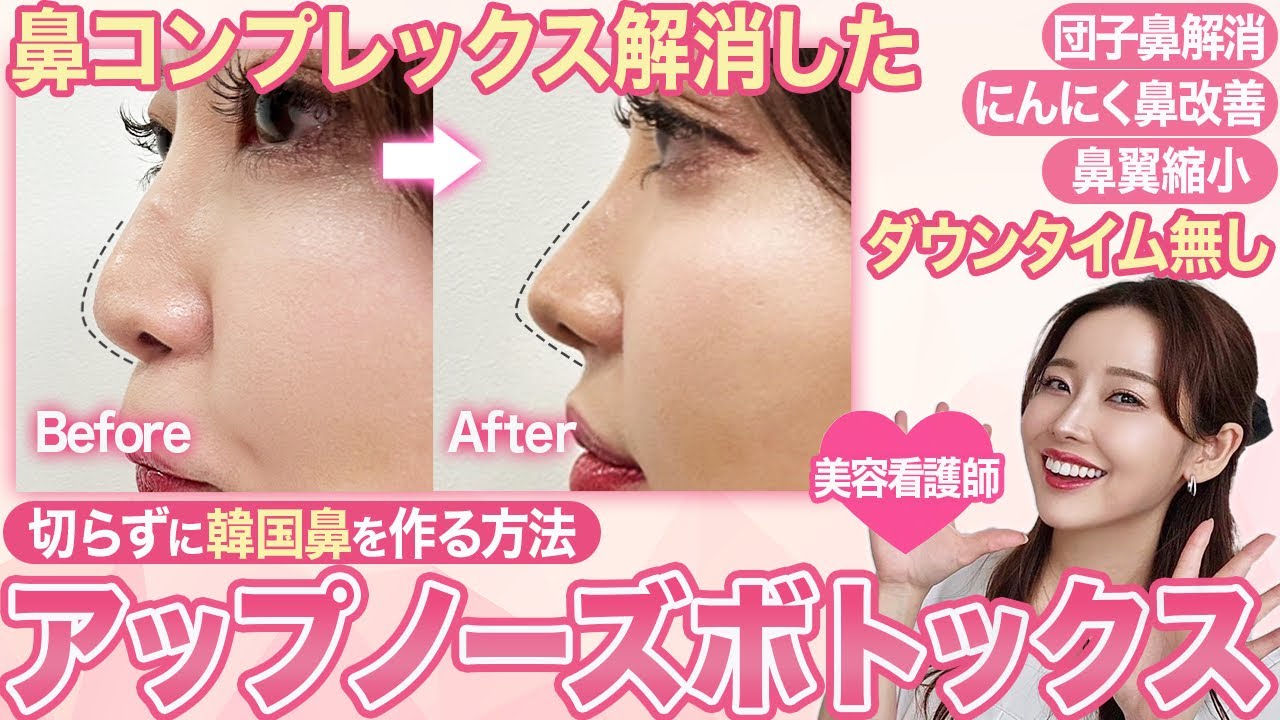 【ボトックス徹底レポ】切らずに団子鼻を解消しました🥲美容看護師が感動した超絶オススメボトックスについて。鼻翼縮小、可愛くなりたい、綺麗になりたい、年々鼻が大きくなる、必見です。