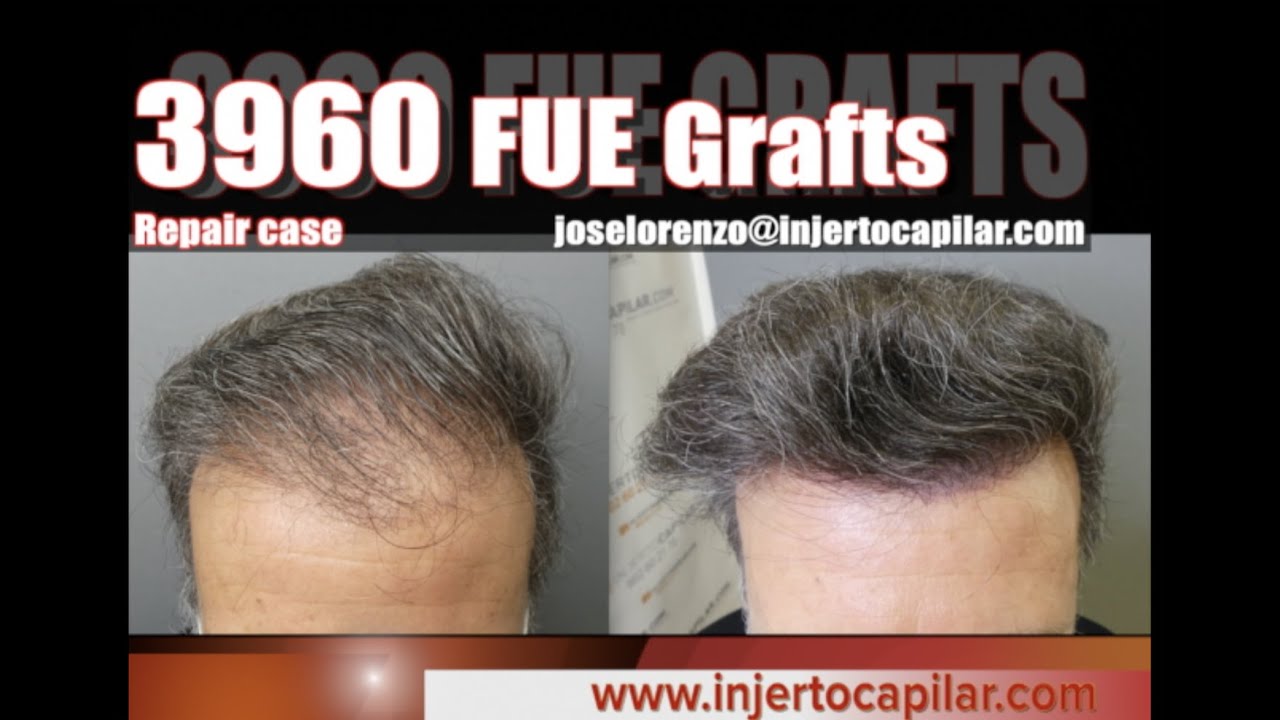 3960FUE Grafts.NW IIIV.Repair case with plugs extraction.Final outcome. Injertocapilar.com.2591/2020