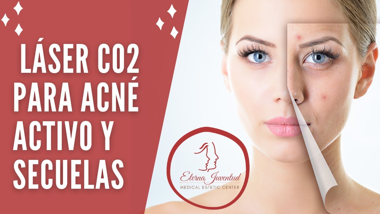 Tratamiento con Láser co2 Fraccionado para Atenuar Acné Activo y Secuelas de Acné en Eterna Juventud