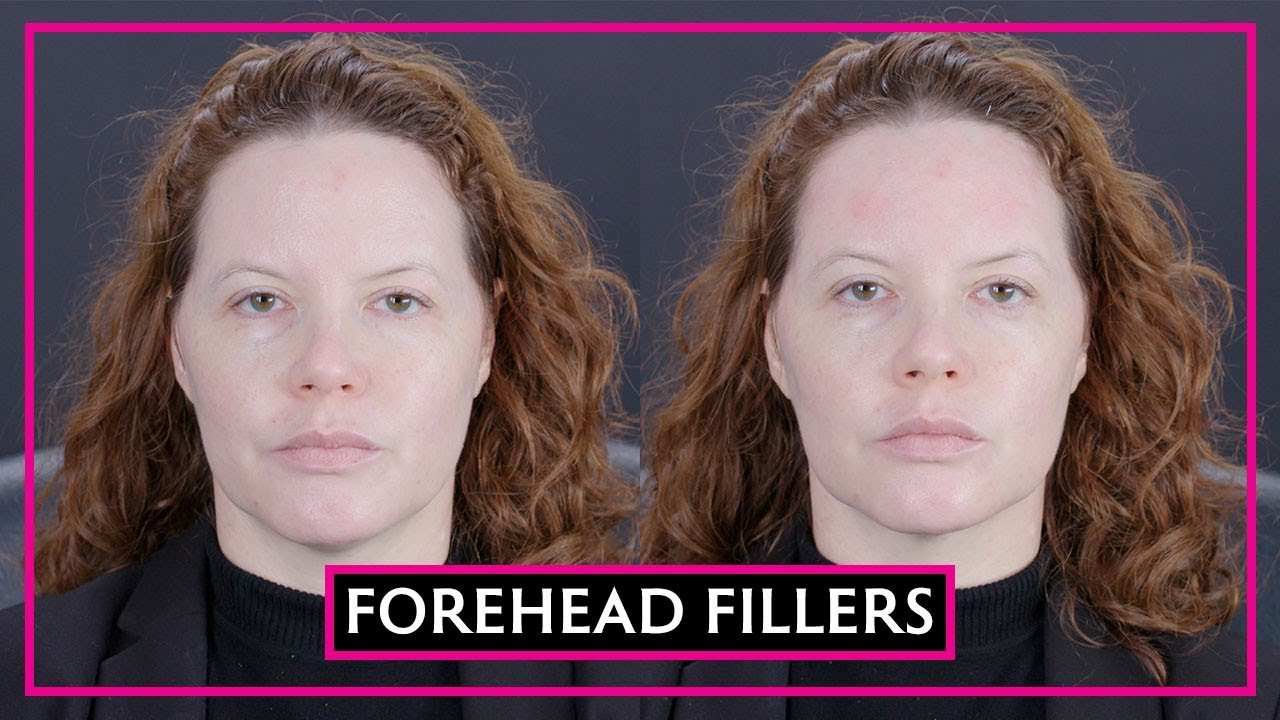 Dermal Fillers For Your Forehead?!