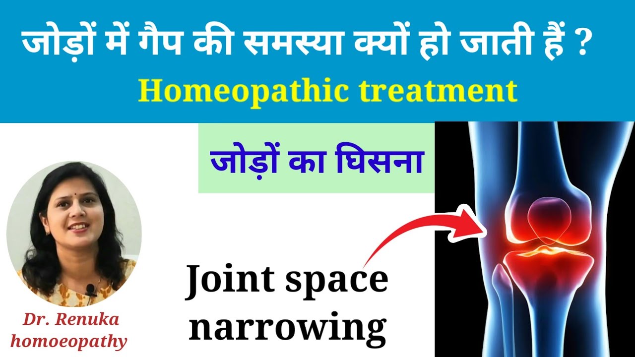 जोड़ो में गैप की समस्या, joint space narrowing homeopathic treatment, जोड़ों का घिसना।