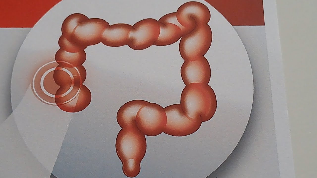 Tumore del colon-retto, ecco i farmaci che “affamano” il tumore e ne bloccano la crescita