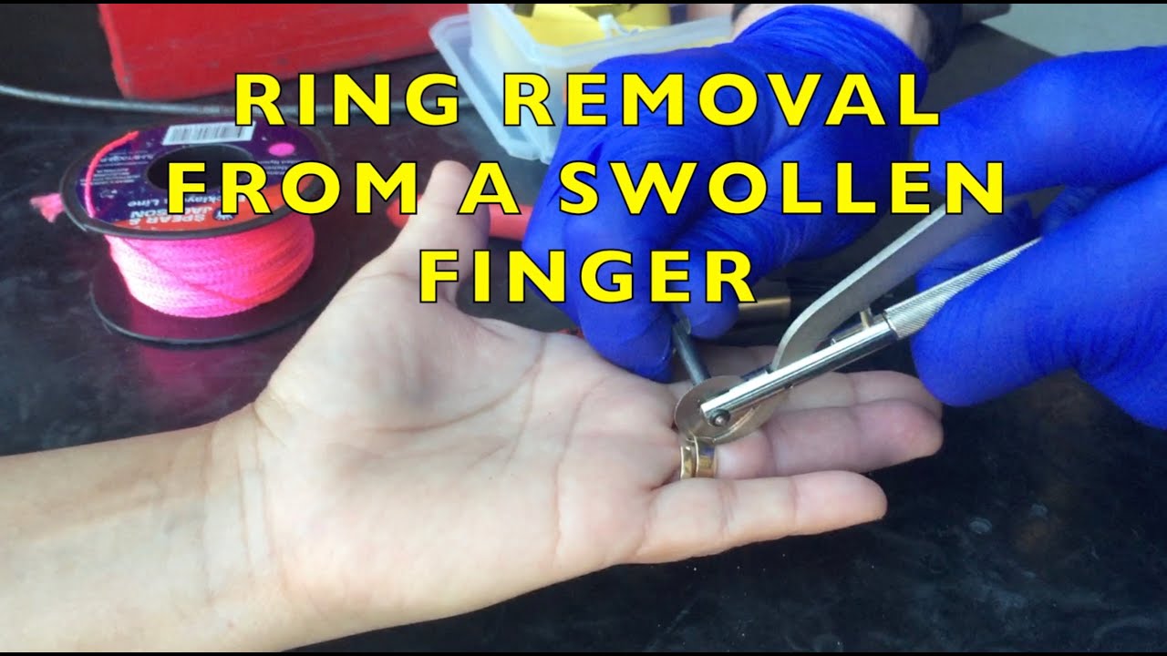 Rescue - REMOVING A RING FROM A SWOLLEN FINGER