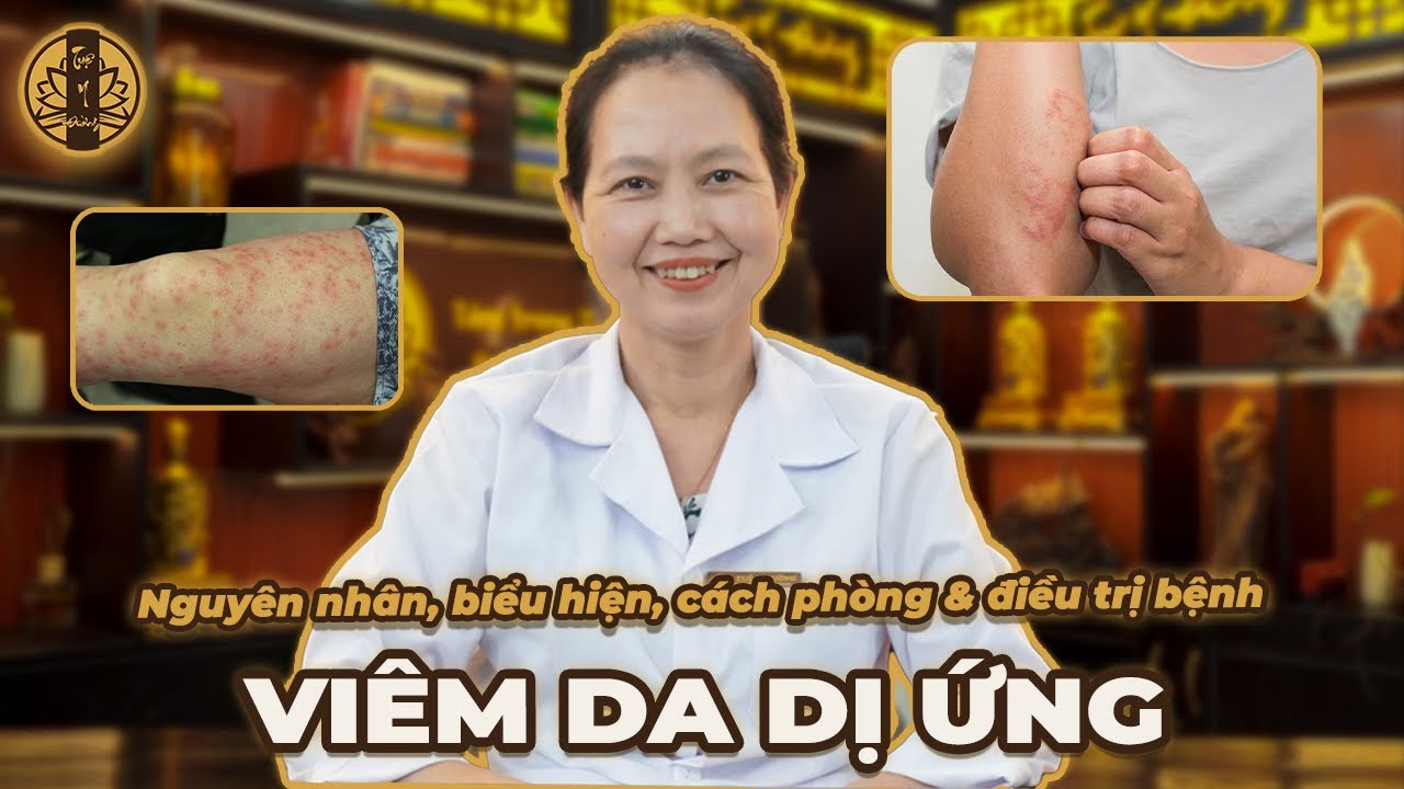 VI&Ecirc;M DA DỊ ỨNG - Nguy&ecirc;n nh&acirc;n, biểu hiện, c&aacute;ch ph&ograve;ng & điều trị m&agrave; bạn chưa biết