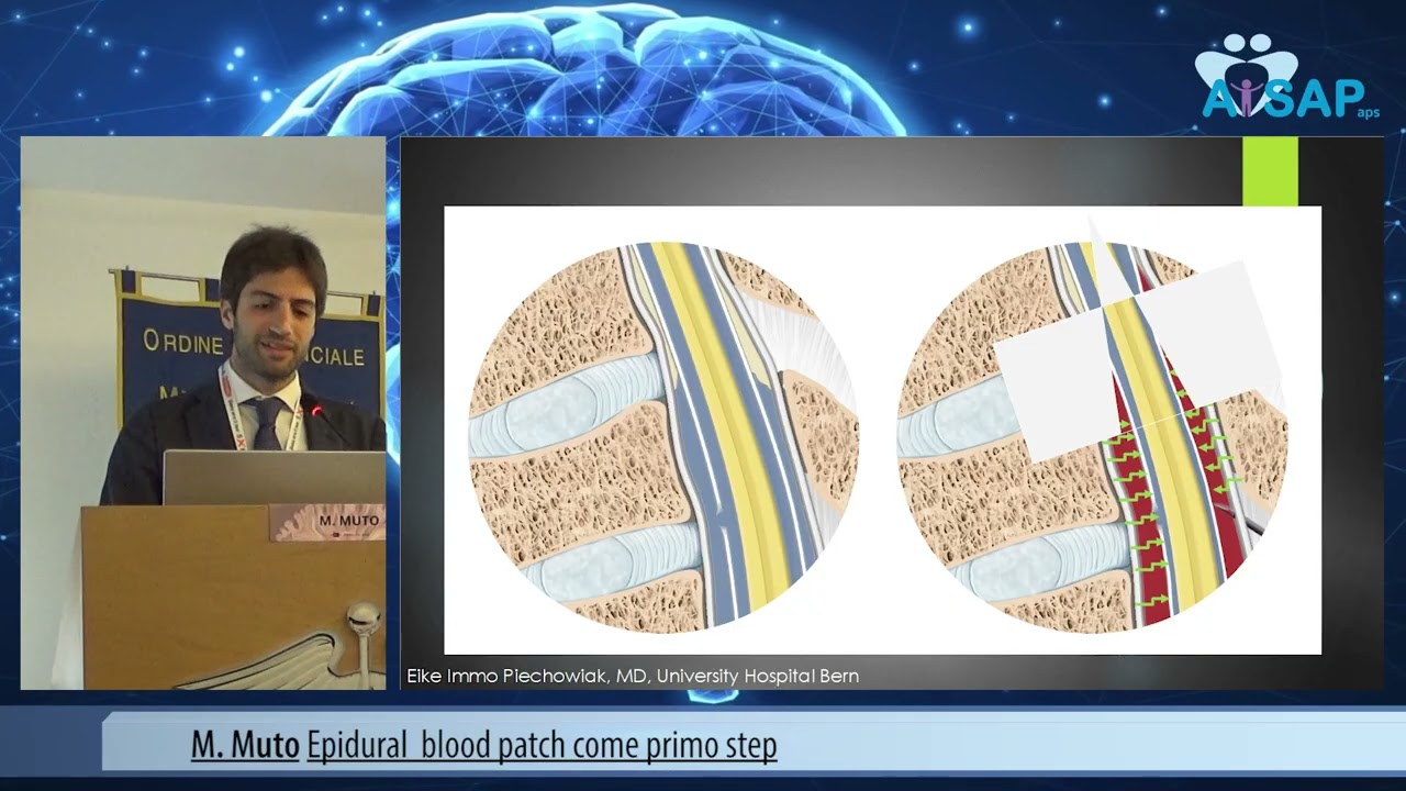 M. Muto Epidural  blood patch come primo step prproj