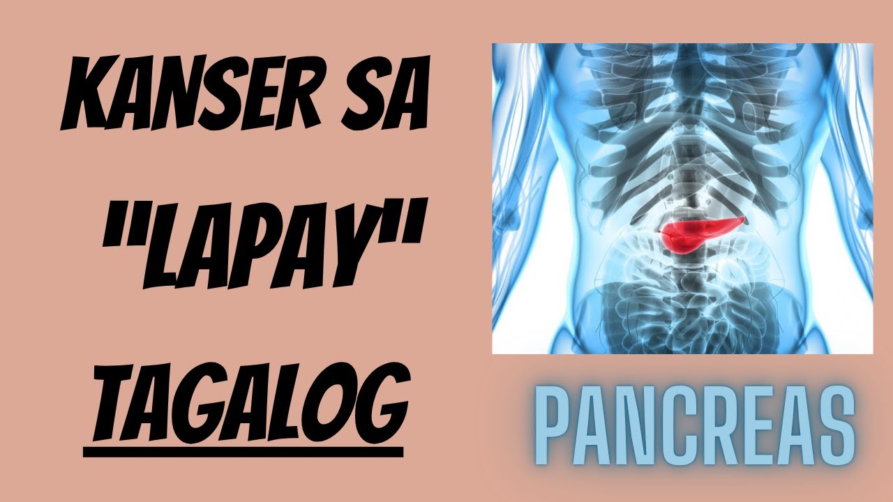 Alamin Natin Paano Maiiwasan ang Kanser sa Lapay (Pancreas)