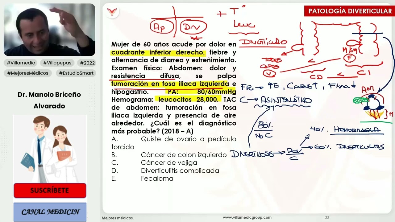 PREGUNTAS ENAM DE PATOLOGÍA DIVERTICULAR - CIRUGÍA GENERAL - VILLAMEDIC