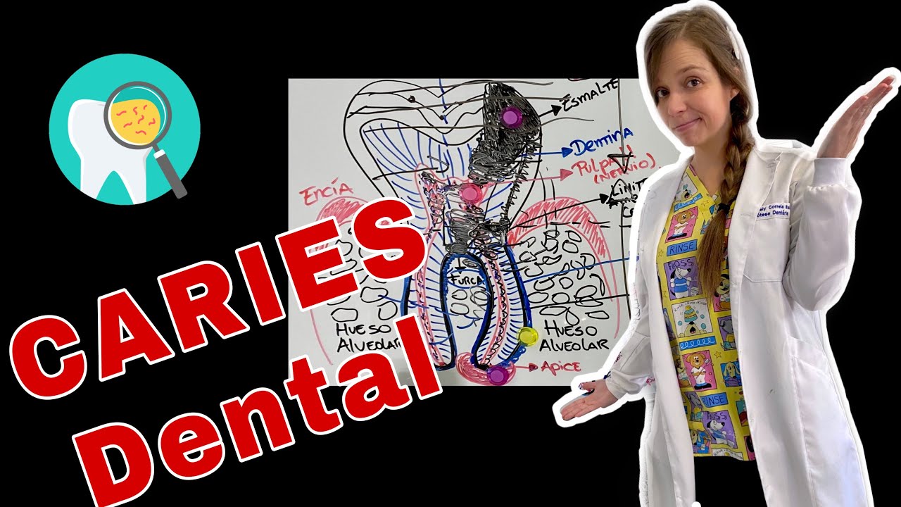 CARIES Dental con la Dra. Marely Correia Balsas #31