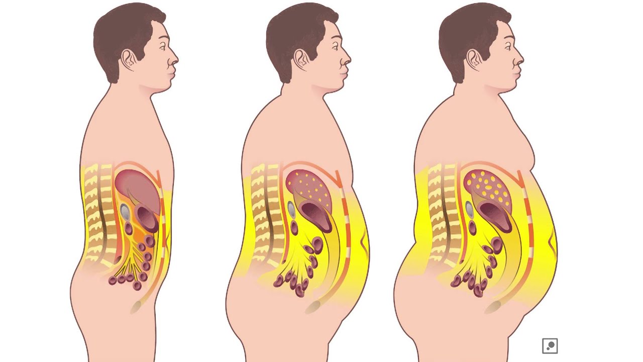 MOOC Nutrición, genes y salud - 5.2. Obesidad, inflamación y complicaciones metabólicas asociadas