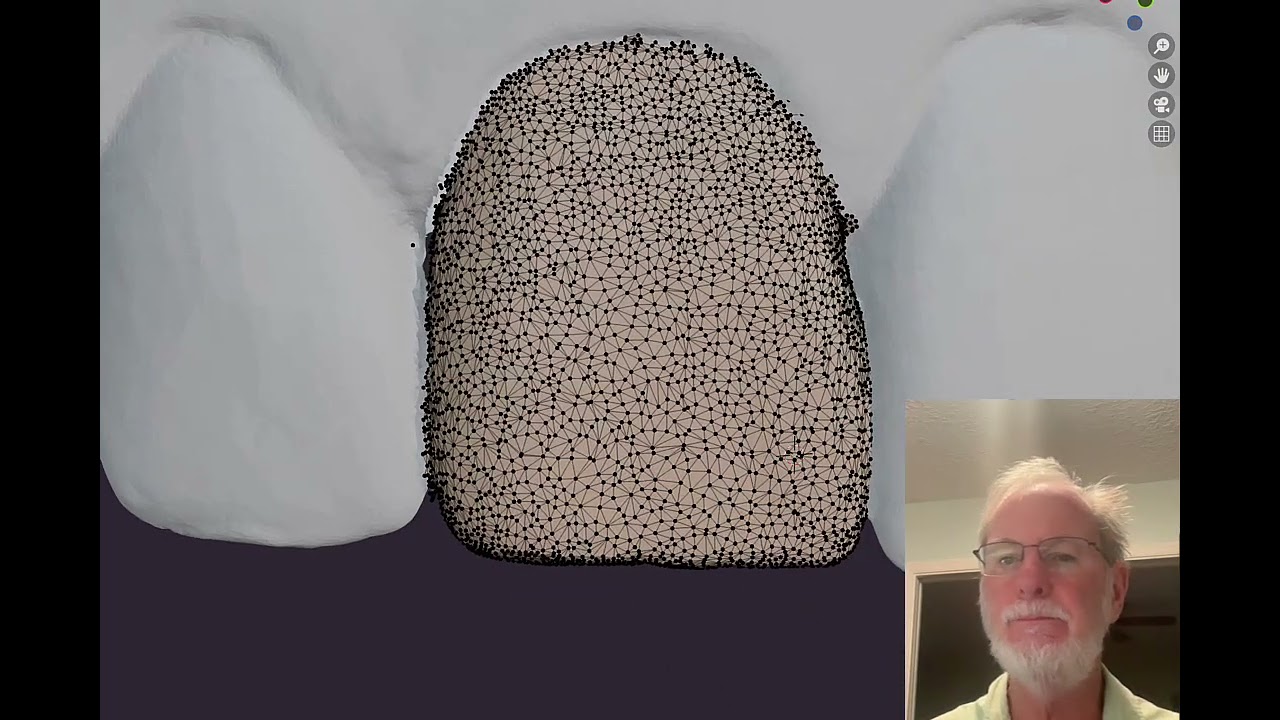 AI Segmentation of teeth  from intra oral scans