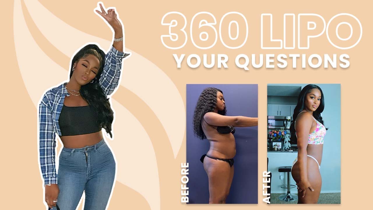 Lipo 360 Review | Taylor Answers Popular Questions About Liposuction and Fat Loss Results