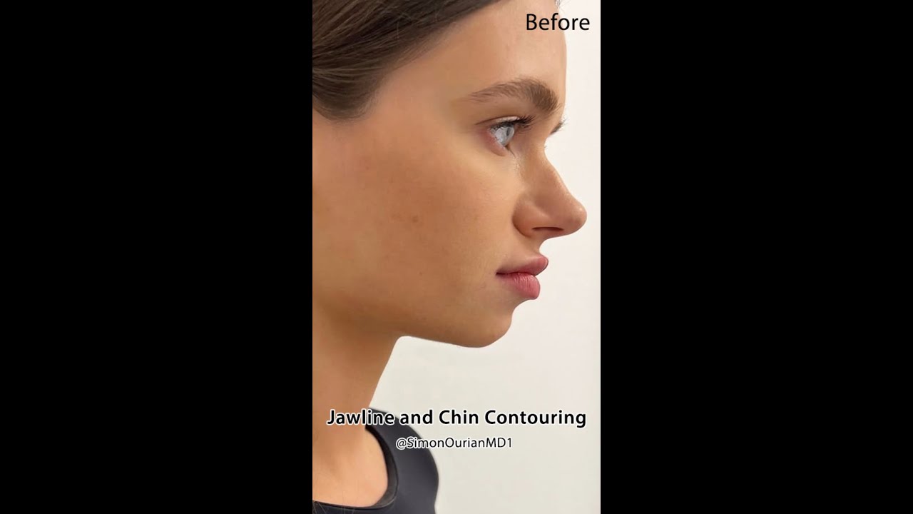 Jawline and Chin Contouring