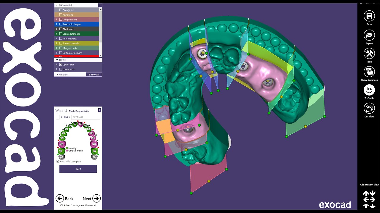 exocad Quick Guide: Implant Model