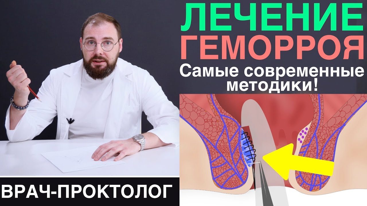 Лечение геморроя - операция Hal-rar, латексное лигирование, удаление лазером, Миллигана-Моргана