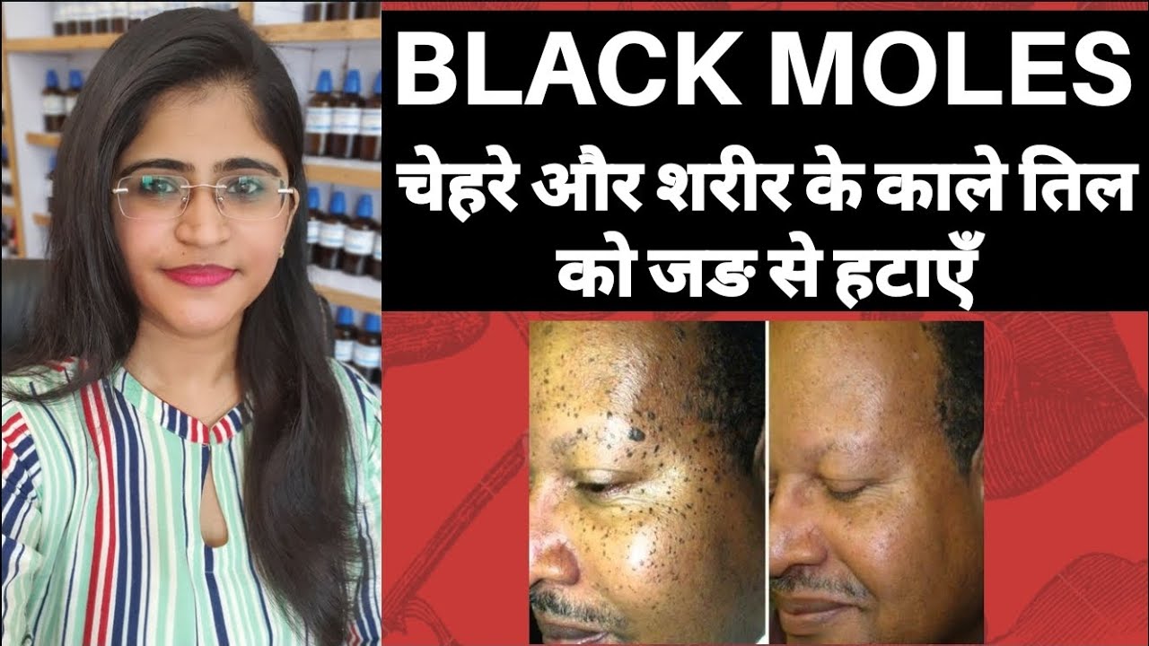 चेहरे पे तिल। ।Mole removal homeopathic medicine।।काले तिल। ।Black Mole medicine।।