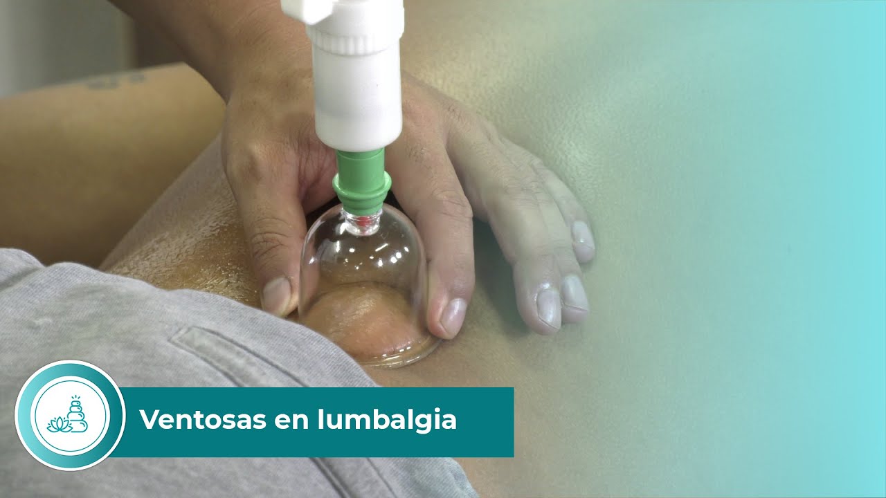 Ventosas en lumbalgia