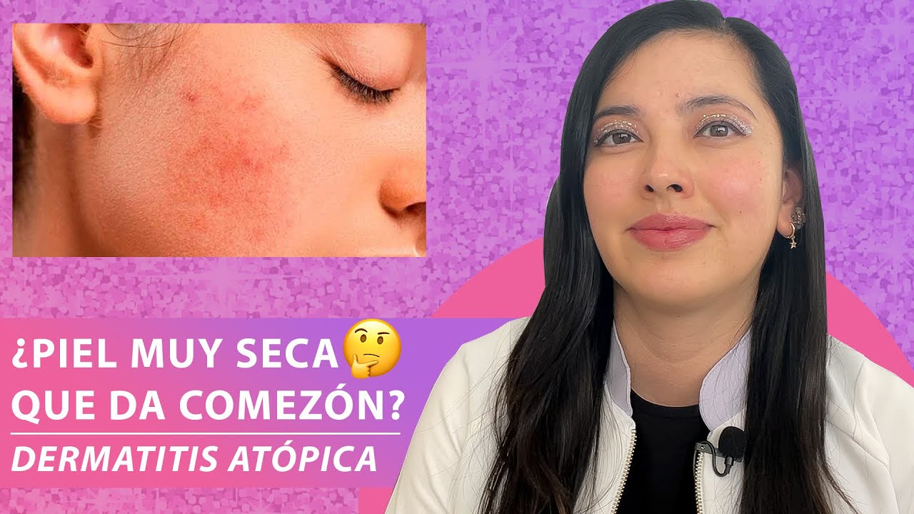 Piel muy seca que da comezón? Podría ser DERMATITIS ATÓPICA