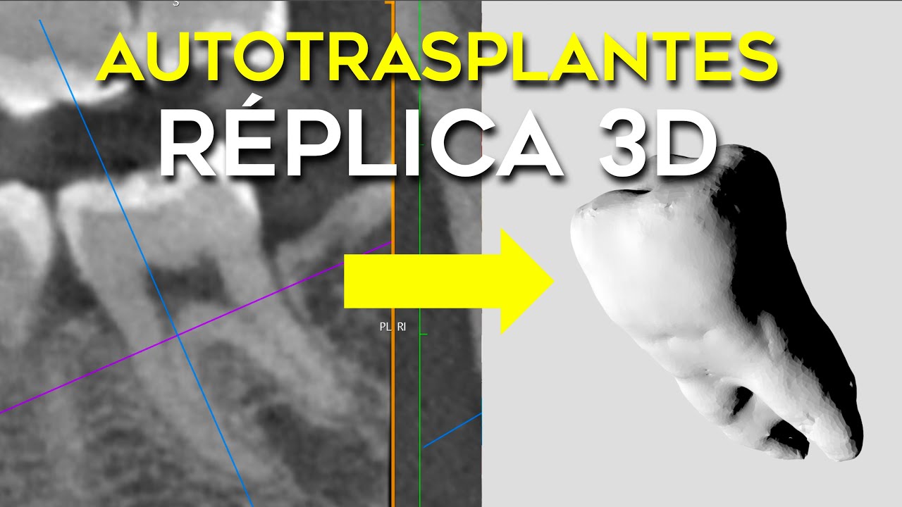 AUTOTRASPLANTE DENTAL ¿CÓMO SACAR UNA RÉPLICA DESDE UNA IMAGEN 3D CBCT PARA IMPRIMIRLA?