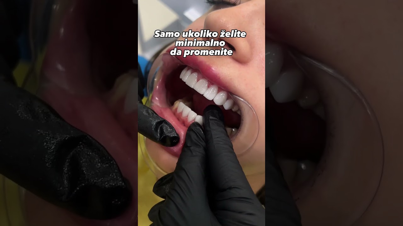 Da li biste i vi radili fasete? #dentist
