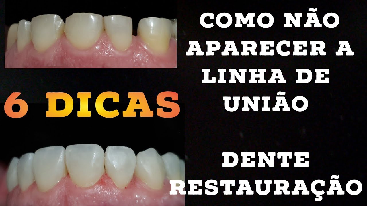 🛑 6 DICAS PRÁTICAS DE COMO NÃO APARECER A LINHA DE UNIÃO DENTE RESTAURAÇÃO EM RESINAS COMPOSTAS! 🤫🤔🔥