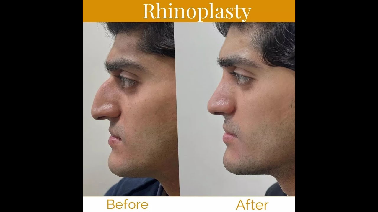 Septoplasty Lahore | Rhinoplasty Surgery Pakistan | nose job, nose surgery - Deviated septum surgery
