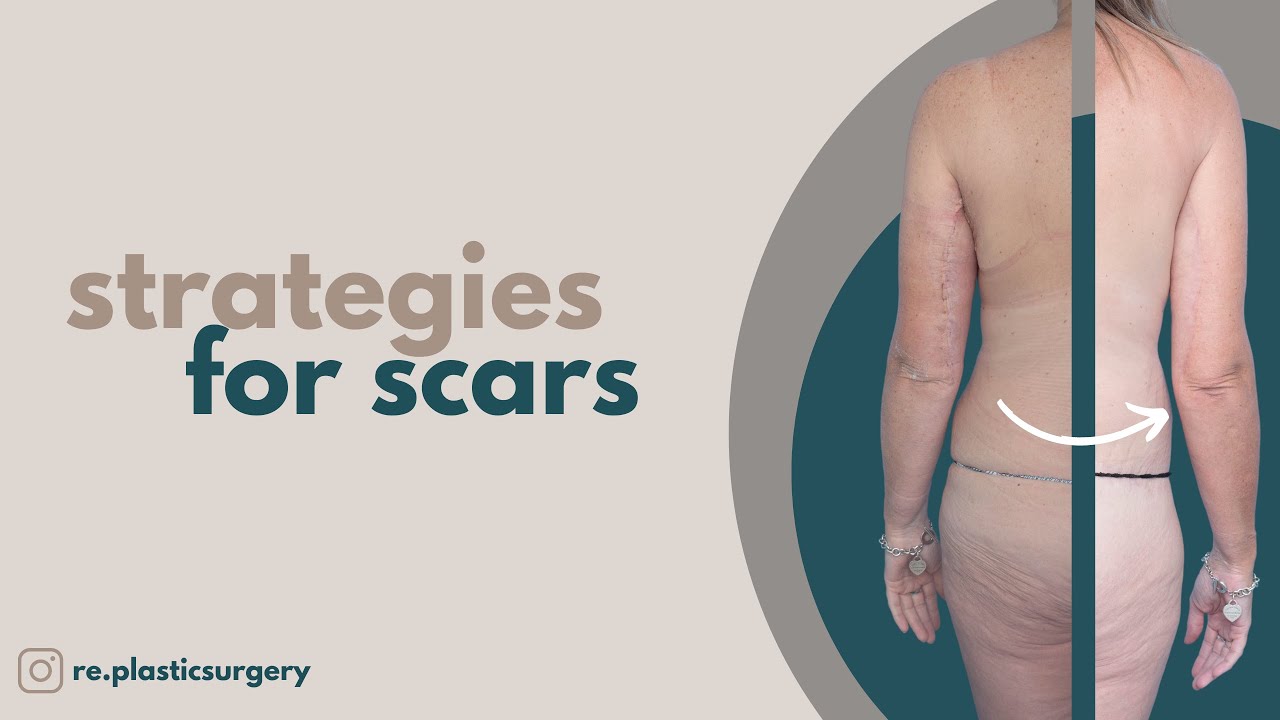 Strategies for Scars