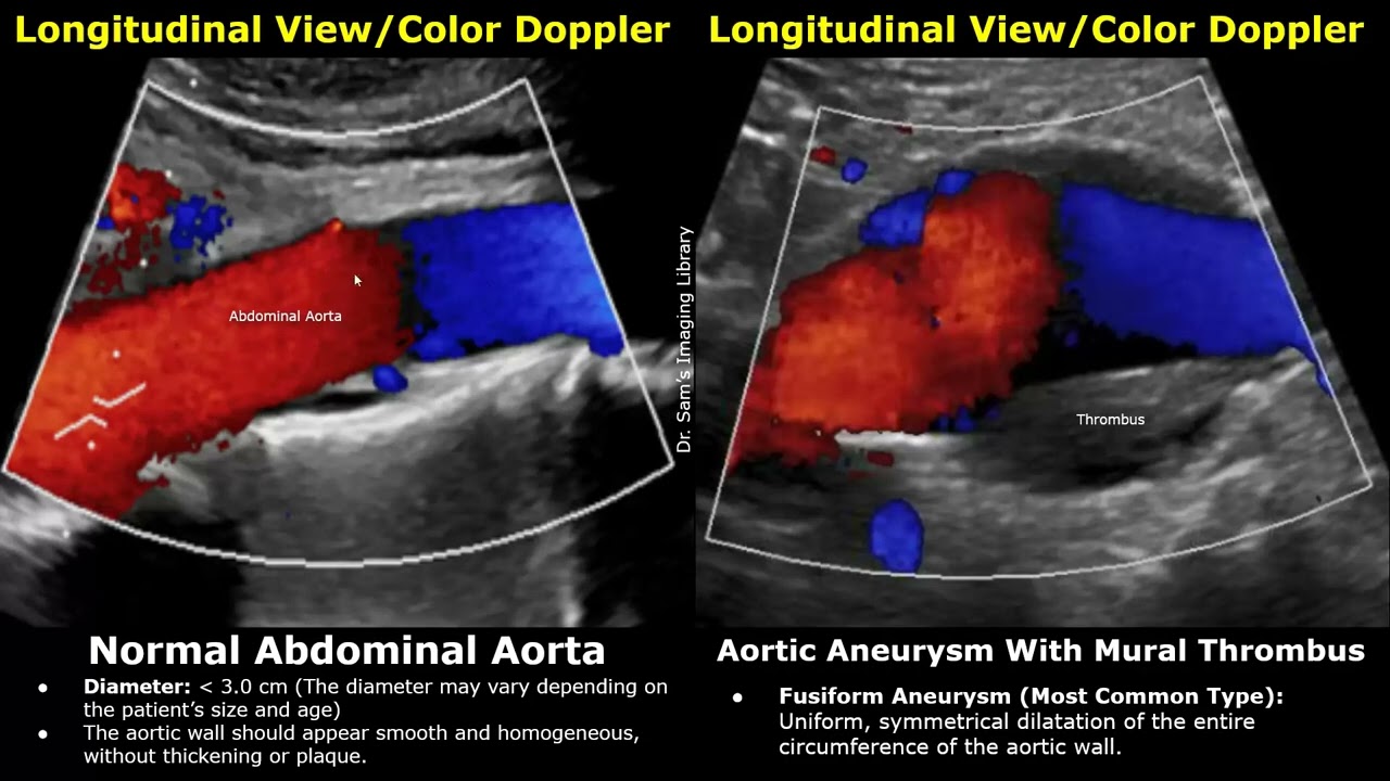 Abdominal Aorta Doppler Ultrasound Normal Vs Abnormal | Aneurysm, Dissection, Stenosis & Rupture USG