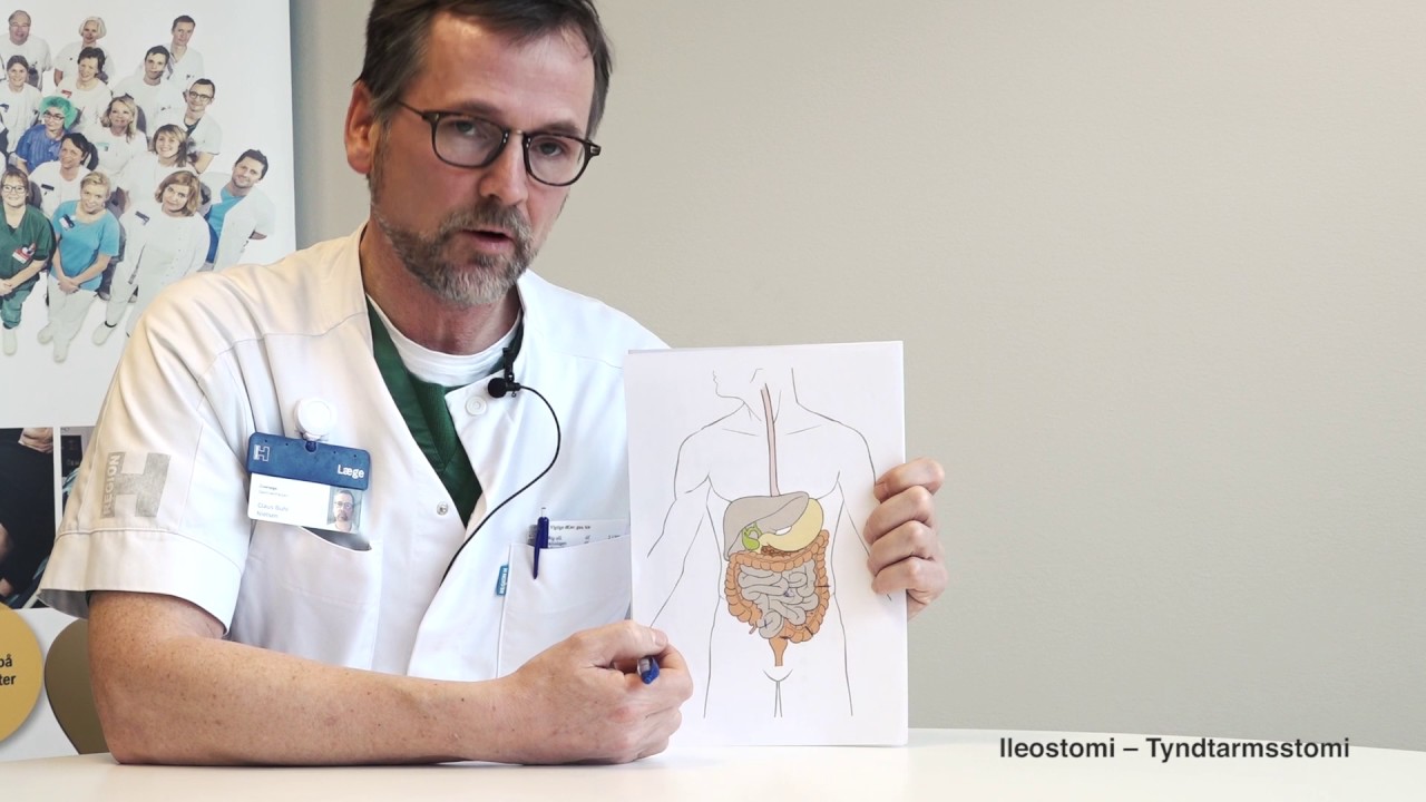 Stomiguiden.dk - Hvordan får man en Ileostomi?