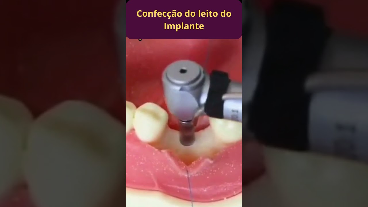 IMPLANTE DENT&Aacute;RIO PASSO A PASSO - COMO &Eacute; FEITO UM IMPLANTE DENT&Aacute;RIO