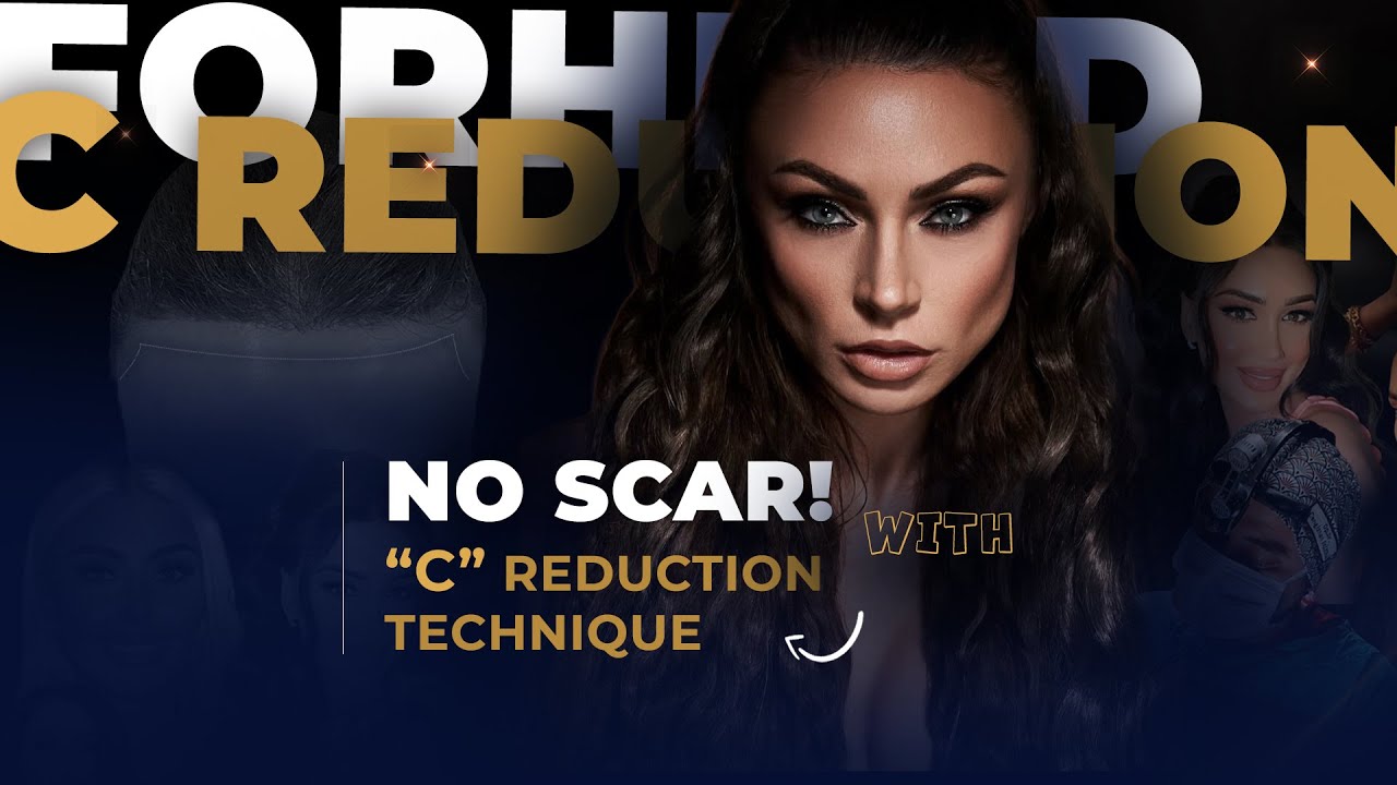 Natural Results: Forehead Reduction with C Technique