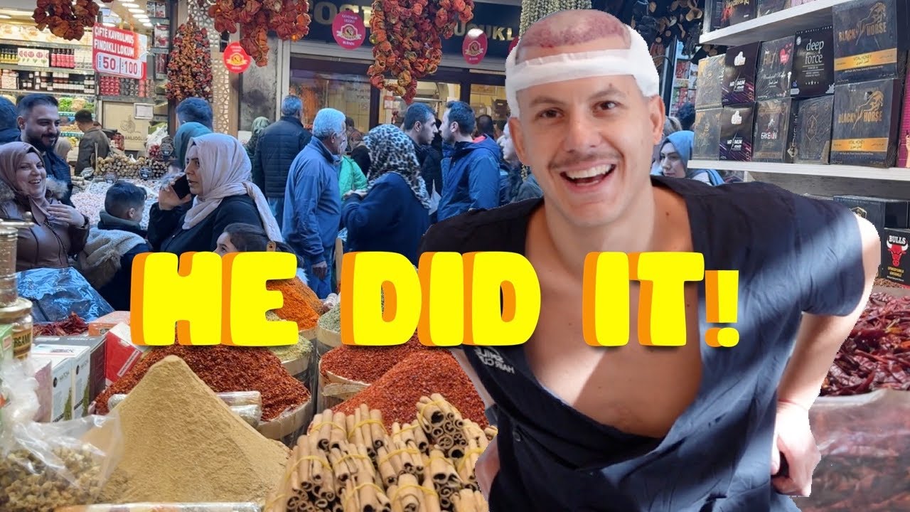 When in Turkey&hellip;. Eat, sleep, HAIR TRANSPLANT, repeat!!
