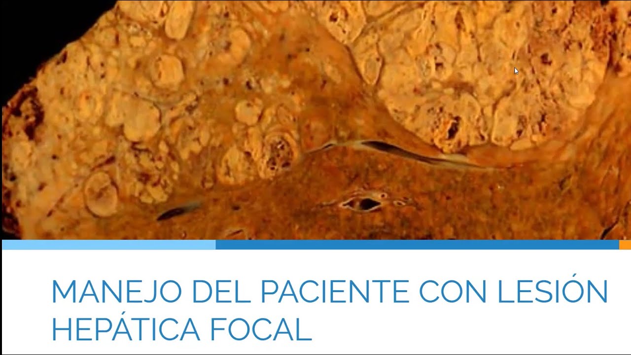 Manejo del paciente con lesión focal hepática